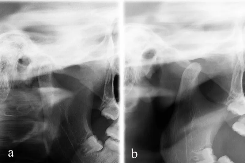 Tooth Subluxation Radiology